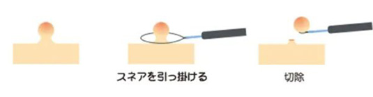 日帰りポリープ切除