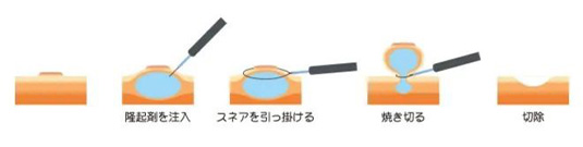 日帰りポリープ切除