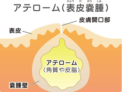 粉瘤
