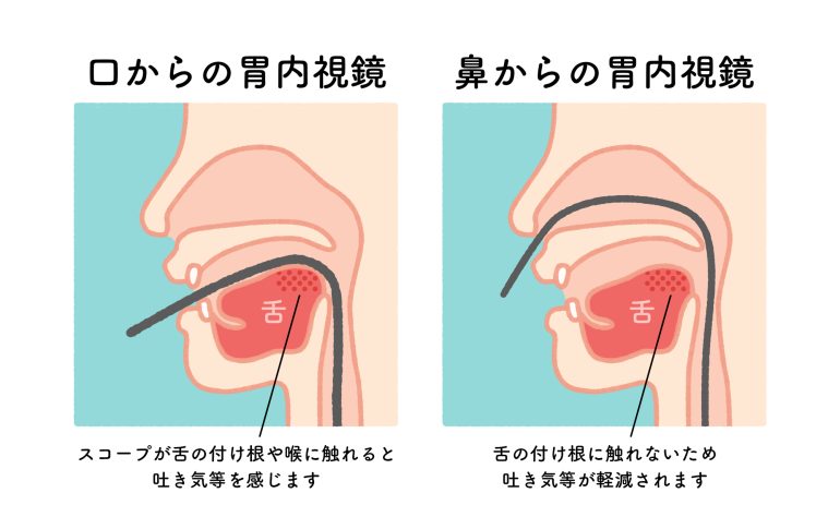 経口内視鏡・経鼻内視鏡